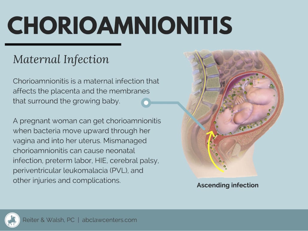 Todo sobre la corioamnionitis y las “infecciones intrauterinas” | ABC Law  Centers: Birth Injury Lawyers, image size:1030x773
