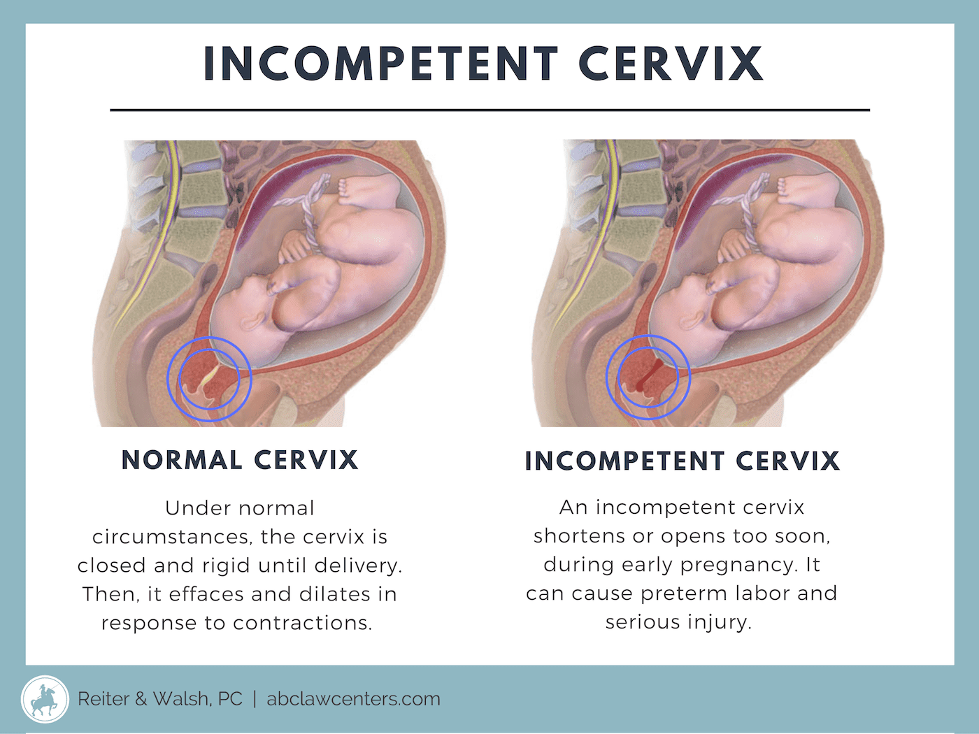 Signs and Symptoms of Incompetent Cervix | ABC Law Centers: Birth Injury  Lawyers, image size:1400x1050