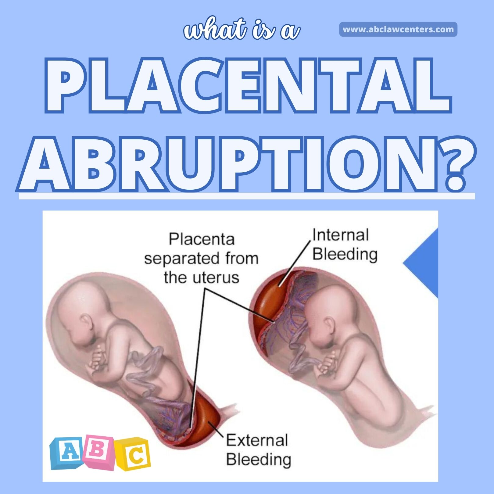 Placental Abruption During Labor \u0026 Delivery | Birth Injury Lawyers, image size:1620x1620
