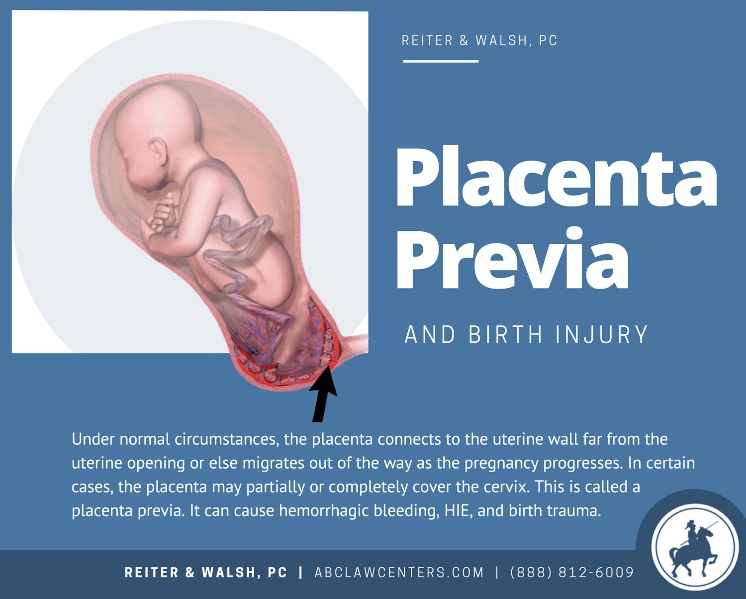 Placenta Previa and Birth Injury, image size:1500x1204