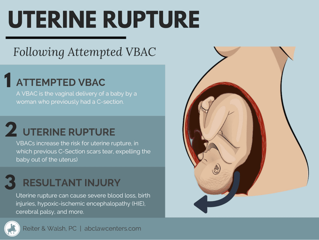 VBAC (Vaginal Birth After C-Section) Delivery | ABC Law Centers: Birth  Injury Lawyers