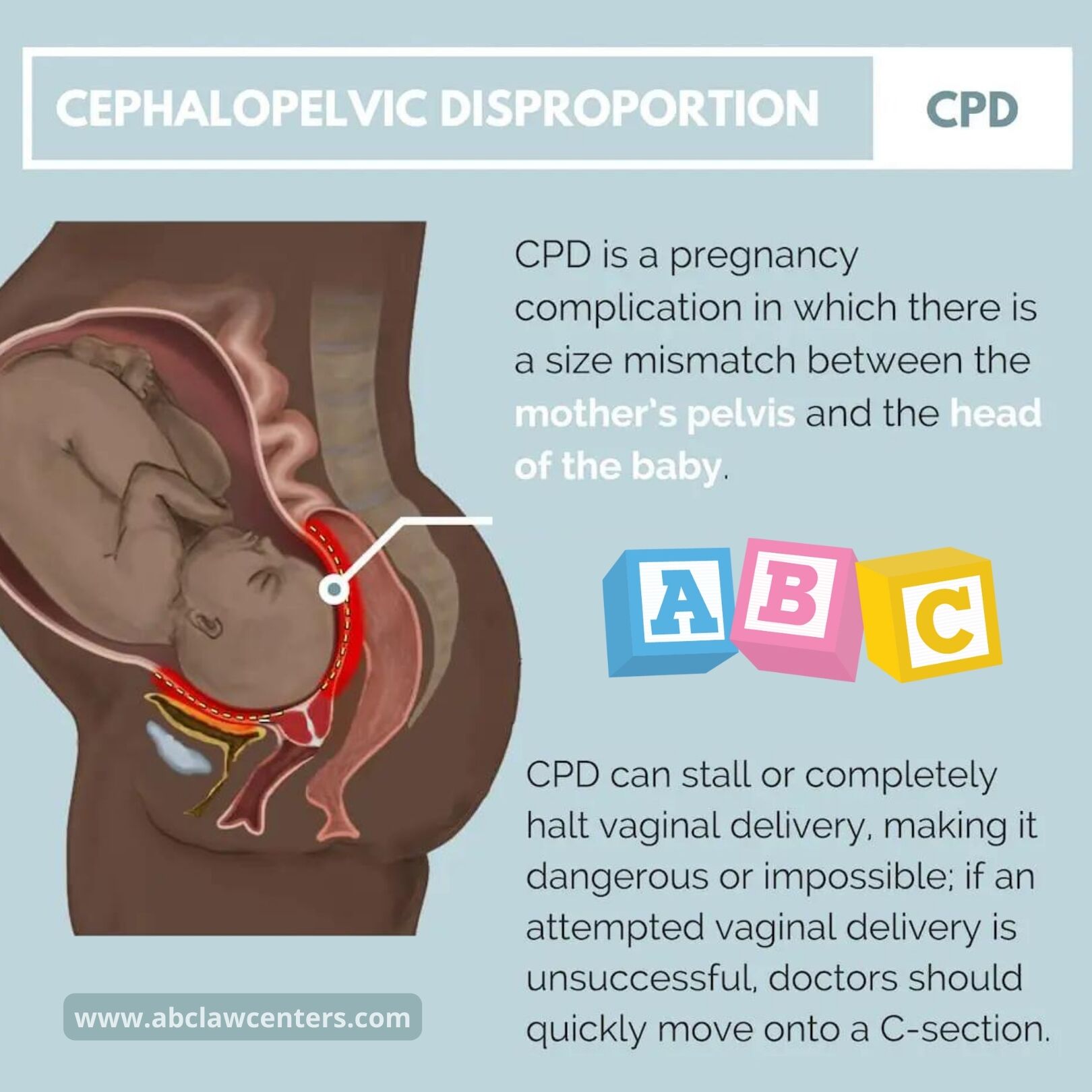 Cephalopelvic Disproportion
