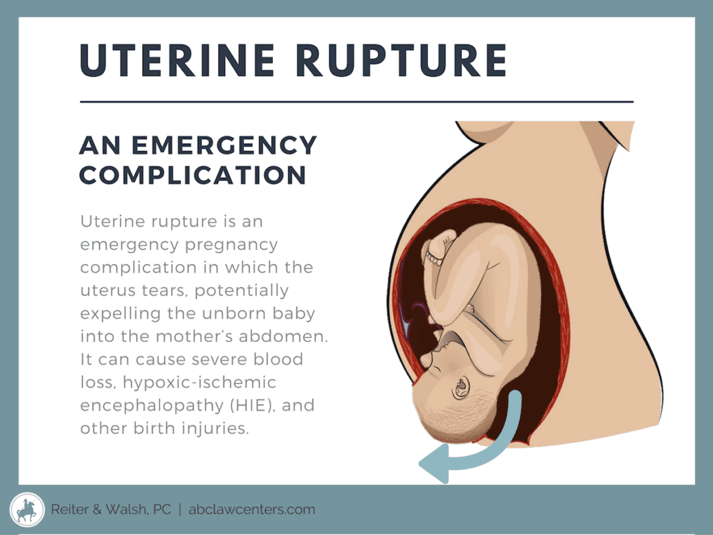 Uterine Rupture and Birth Injuries   Legal Help